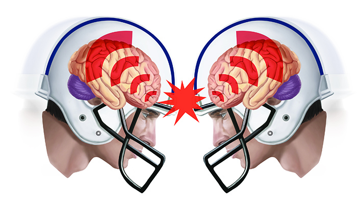 How Does a Helmet Protect against Concussions?